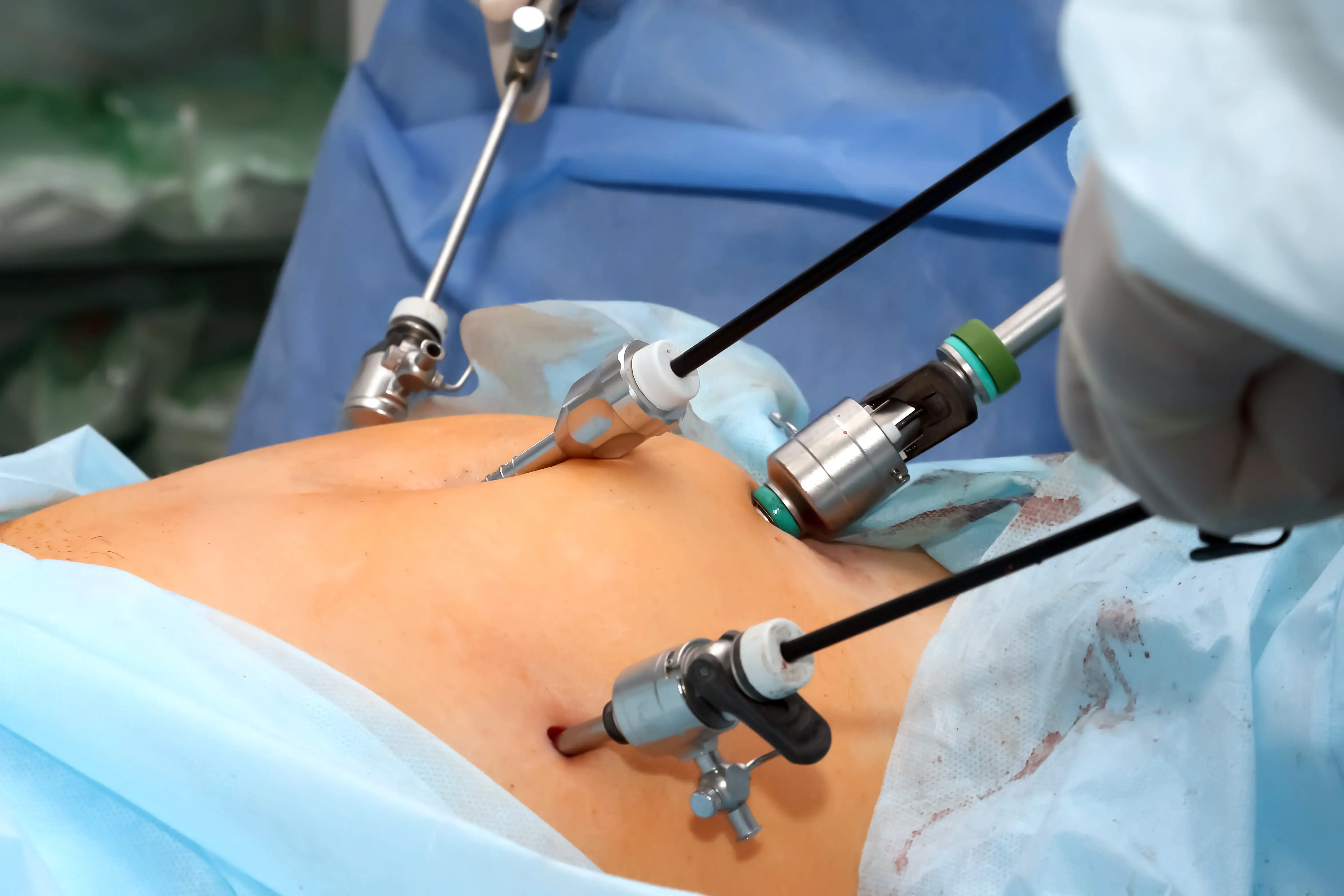 O que perguntar ao urologista antes de operar a próstata?